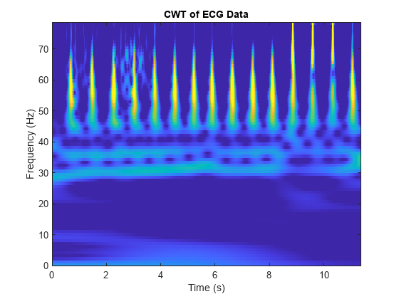 图中包含一个轴对象。心电数据以CWT为标题的轴对象包含一个类型为图像的对象。