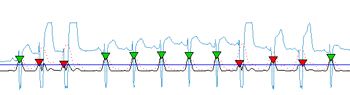 图1所示。一种饱和信号，其值被截断后显示失真。该算法可以在类似的信号中检测QRS。