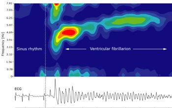 图4。心室颤动的时频分析。在3-6Hz范围内的频率峰值表明纤维性颤动或颤振。