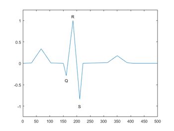 图2。心电图信号产生的QRS波群。