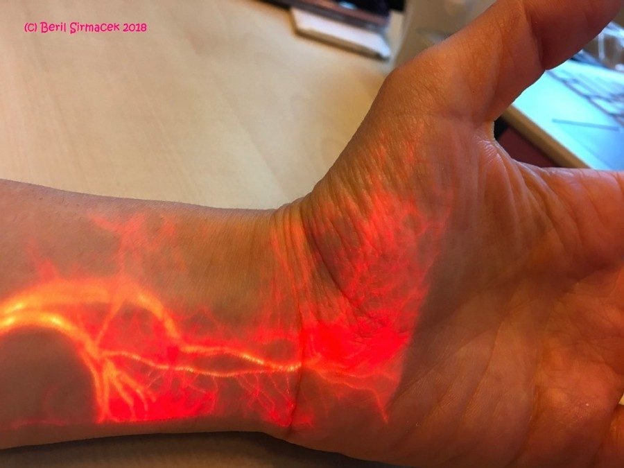 图1。手腕和手部血流的增强现实可视化。