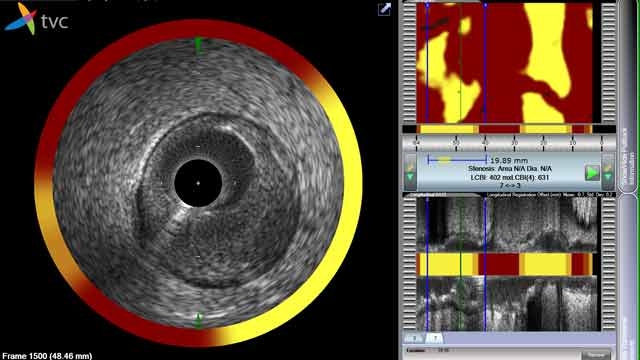 的TVC成像系统的用户界面，与可视化工具，用于横向IVUS，chemogram，和纵向IVUS。