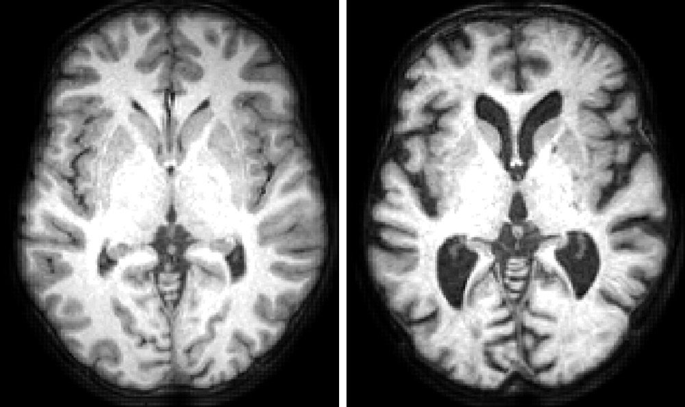 图1所示。结构核磁共振成像显示一个典型的健康19岁的人的水平切片和一个典型的健康86岁的人的大脑。