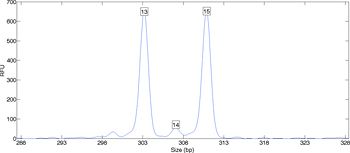 图1所示。DNA数据显示两座山峰,一个人的(13、15)基因型可以推断。