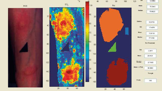 来自诺丁汉大学的高光谱图像，通过照射组织表面，准确测量氧含量并生成氧饱和度图，以方便临床研究人员和医生的工作。