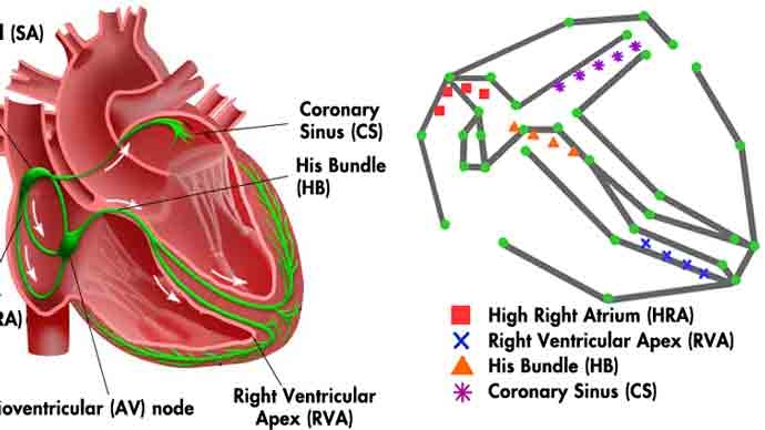 宾夕法尼亚大学为心脏起搏器的实时闭环测试开发了电生理心脏模型