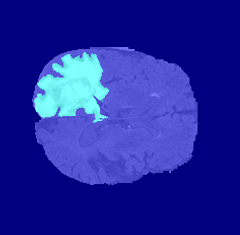 人脑轴向切片，彩色像素标记覆盖，显示正常组织和肿瘤组织区域