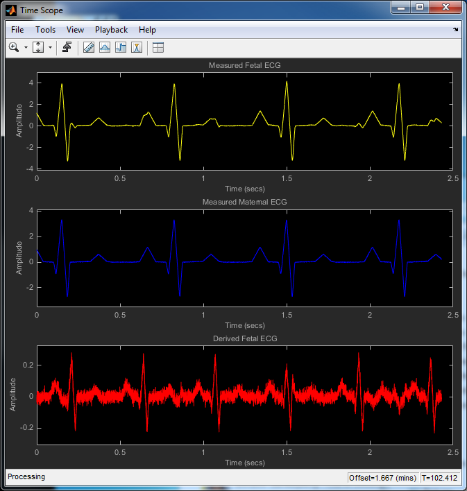 自适应噪声抵消（ANC）在胎儿心电图中的应用