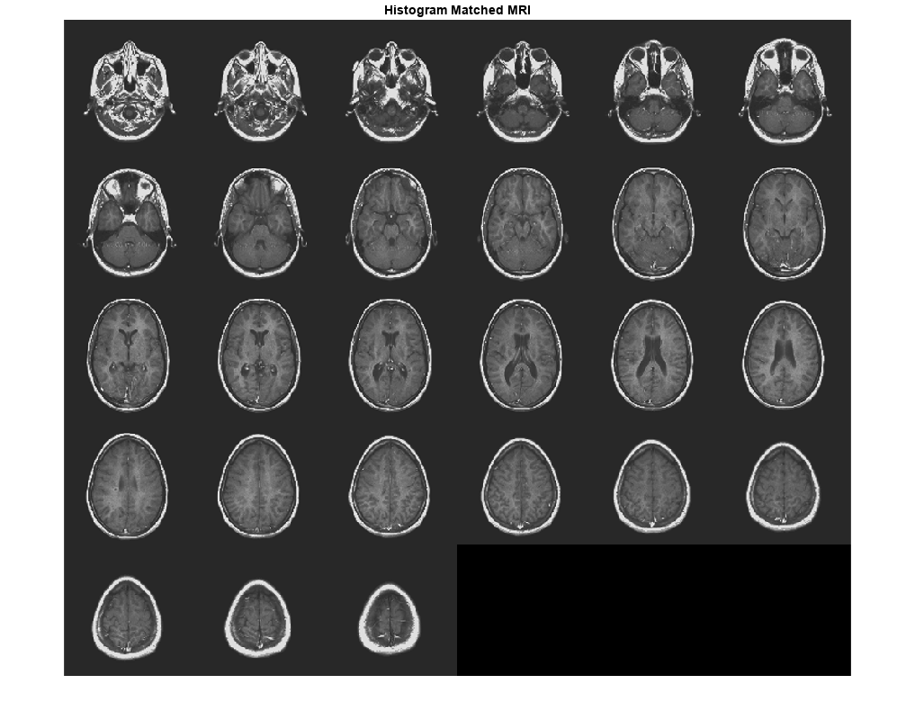 图包含一个轴对象。The axes object with title Histogram Matched MRI contains an object of type image.