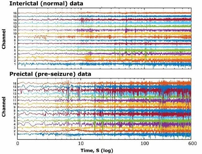 在正常和预癫痫发作期间，对应于从癫痫对象获得的EEG记录的多个信号数据通道。