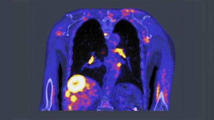 PET扫描使用一种被称为示踪剂的少量放射性药物来突出癌细胞