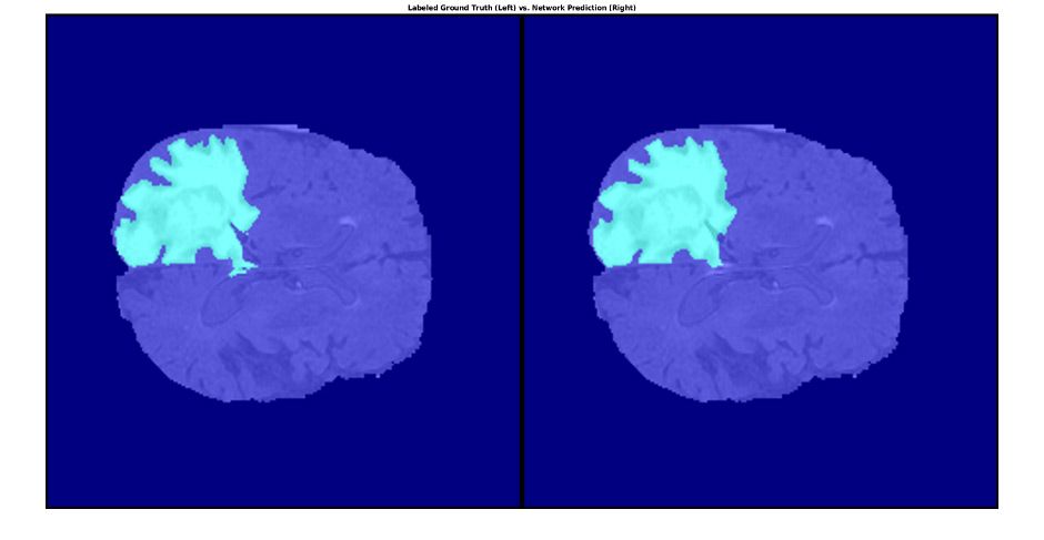 用MATLAB在脑组织中分割肿瘤，左为标记地面真相，右为网络预测。