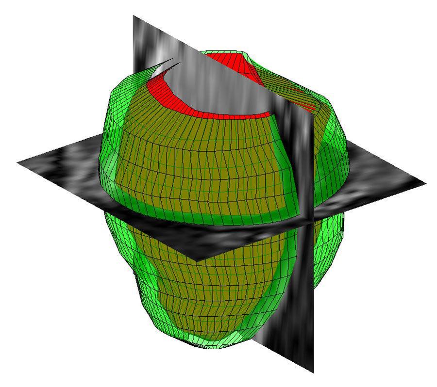 利用MATLAB对MR图像进行人左心室的三维几何重建。