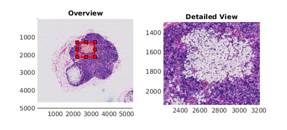 MATLAB中使用<code>bigimageshow</code>显示含有肿瘤组织的淋巴结图像。