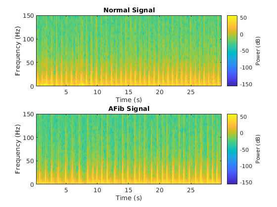 長短期記憶ネットワクを使用したecg信号の分類