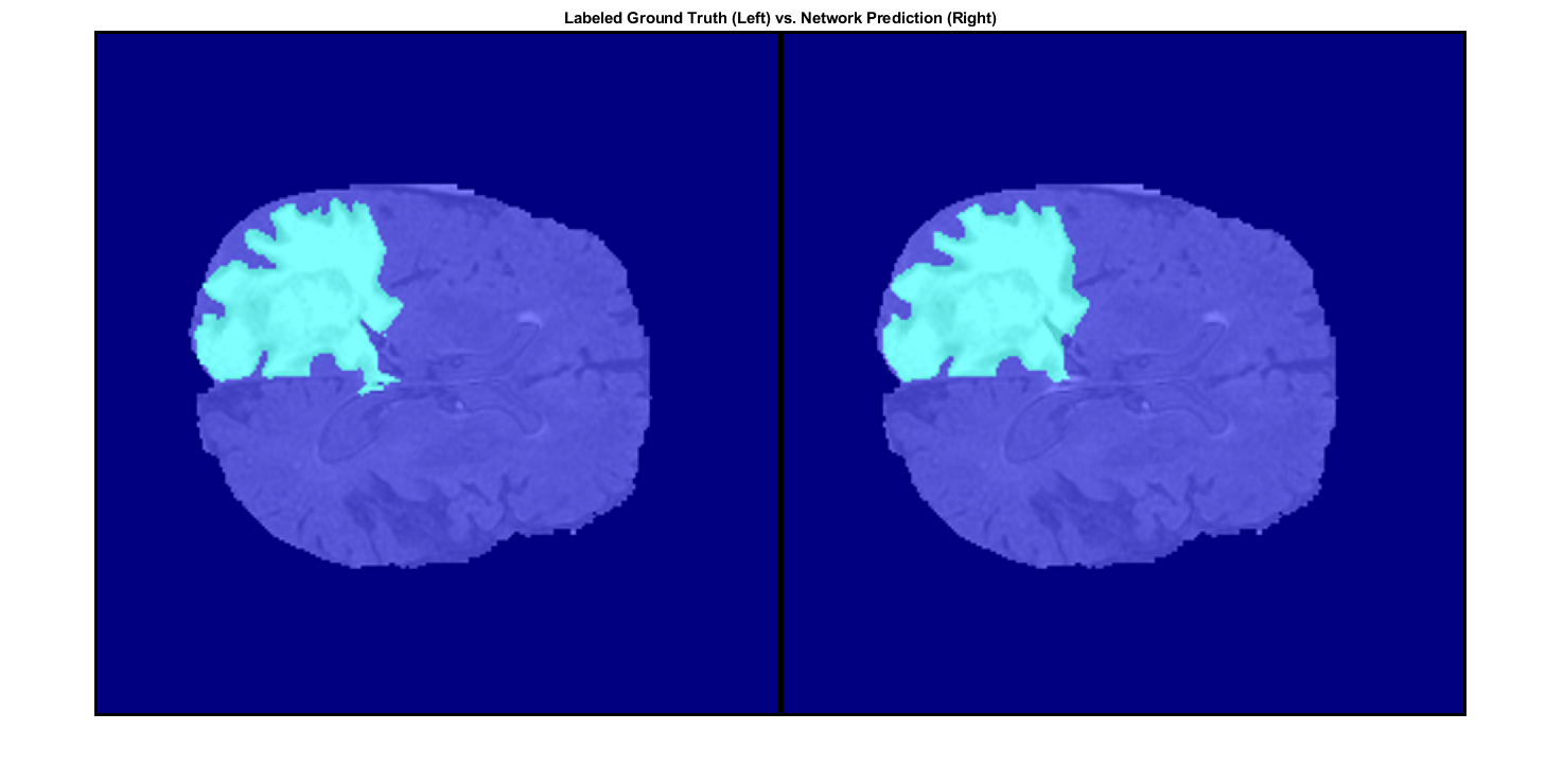 Segmentación德tumores cerebrales 3D mediante aprendizaje profundo