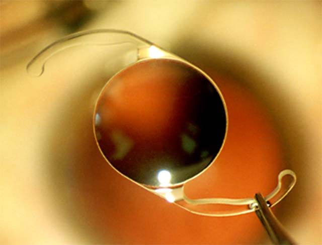 用镊子将人工晶状体夹在眼睛上方的特写镜头。