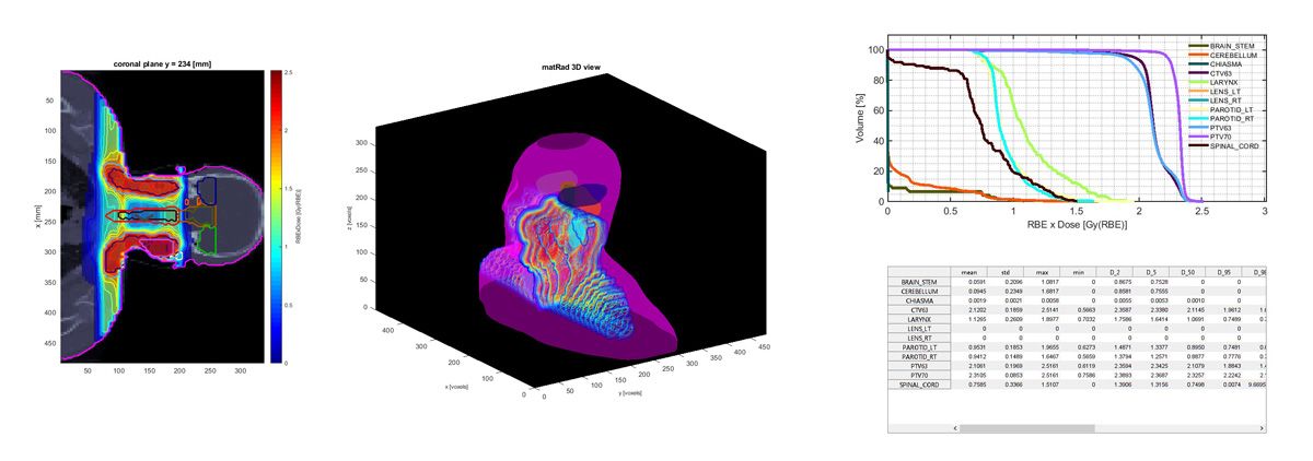 图4。在matRad中生成的可视化。左:头颈癌患者冠状面CT和计划质子剂量。中心:同一可视化的3D渲染。右:样品剂量直方图和统计表。