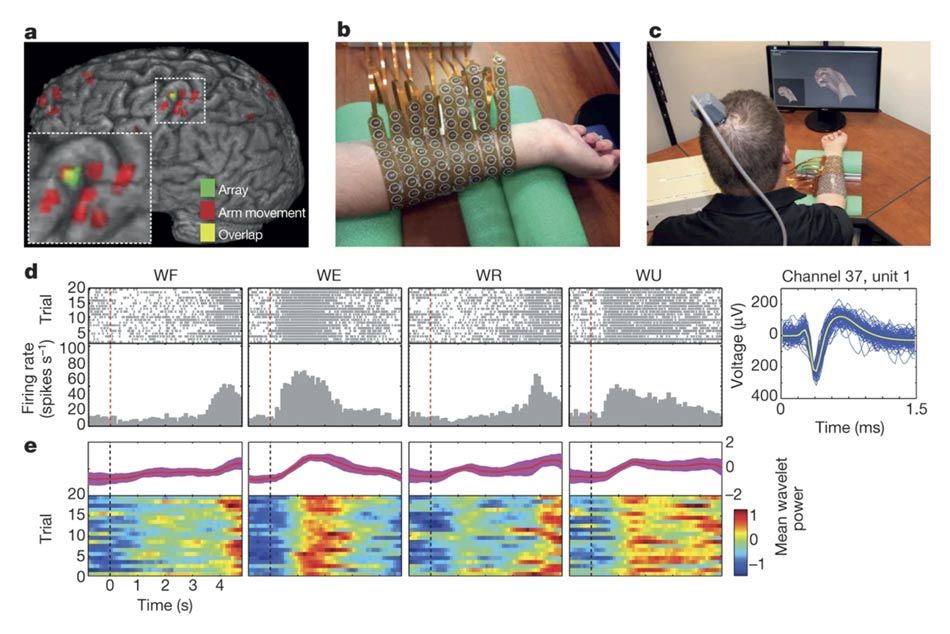 这张图片来自2016年的神经生命研究。左上角是大脑的图像，显示了植入微电网阵列的位置。中上显示Burkhart的前臂被电极套住。右上显示Burkhart正对着电脑显示器。在显示器上是一个头像，如果他的右手。他戴着电极套。图片底部显示了一系列灰度直方图和多色光栅读数，这些读数与尝试手腕运动时神经元的活动相对应。