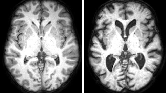 加速神经影像数据分析以研究健康认知老化