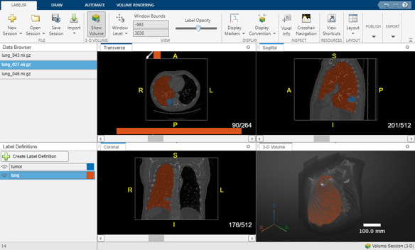 快照的医学图像贴标签机应用,显示了一个3 d CT胸部肿瘤体积与肺癌和标签
